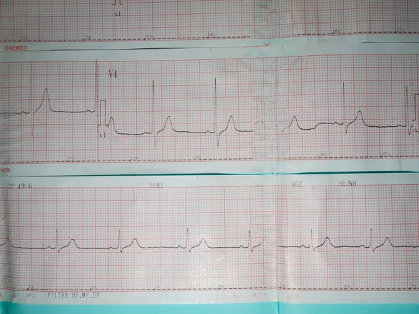 an electrocardiogram or ecg picture that describes a heart rhythm abnormality, namely left ventricular hypertrophy