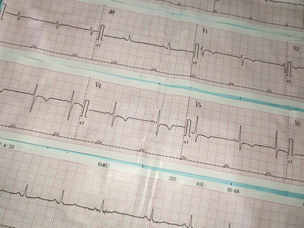 an electrocardiogram or ecg picture that describes a heart rhythm abnormality namely inverted t wave on anteroseptal that usually indicates ischemia on myocard