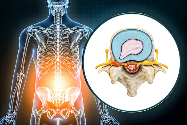 Lumbar hernia and vertebra with herniated disc medical diagram 3D rendering illustration. Backache, spine pathology, injury, osteology, healthcare, science concepts.
