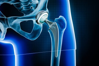 Femoral kafa protezi ya da implant. Toplam kalça eklemi değiştirme ameliyatı ya da eklembacaklı üç boyutlu resimleme. Tıbbi ve sağlık hizmetleri, artrit, patoloji, bilim, osteoloji kavramları.