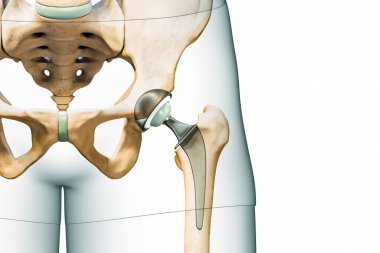 Kalça protezi ya da implant beyaz arka planda izole edilmiş, fotokopi alanı ve vücut hatlarıyla. Kalça eklemi ya da uyluk kemiği protezi 3 boyutlu görüntüleme. Tıp, ameliyat, bilim kavramları.