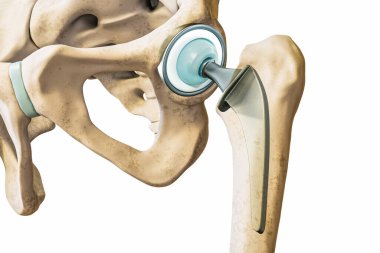 Beyaz arka planda izole edilmiş kalça protezi ya da implant. Kalça eklemi ya da uyluk kemiği protezi 3 boyutlu görüntüleme. Tıp, tıbbi ve sağlık hizmetleri, cerrahi, bilim kavramları.