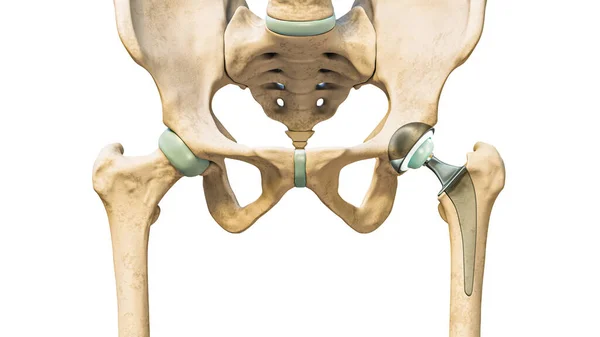 在白色背景下孤立的髋关节假体或植入物 髋关节或股骨头置换三维渲染说明 医疗和保健 骨科概念 — 图库照片