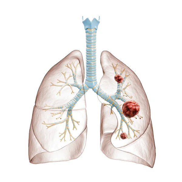 Lung Cancer Carcinoma Rendering Illustration Bronchial Tree Lungs Infected Cancer — Stock Photo, Image