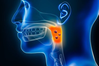 Oropharynx or throat cancer with organs and tumors or cancerous cells 3D rendering illustration. Anatomy, oncology, pharynx disease, medical, biology, science, healthcare concepts. clipart