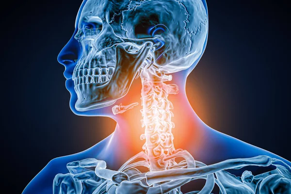 Nyaki Csigolyák Osteoarthritisszel Gyulladással Vagy Sérüléssel Renderelés Illusztráció Anatómia Gerinc — Stock Fotó
