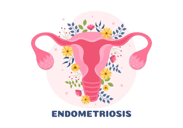 Endometriosis with Condition the Endometrium Grows Outside the Uterine Wall in Women for Treatment in Flat Cartoon Hand Drawn Templates Illustration
