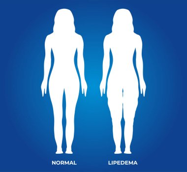 Normal ve Lipedema Bacaklı Kadın Çizimi Silueti