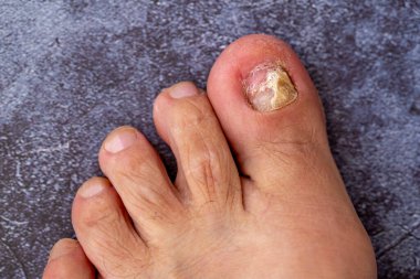 ayak tirnagi mantar enfeksiyonu doruğuna.