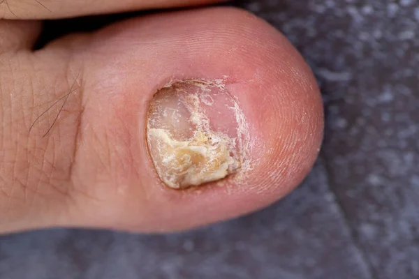 stock image A toenail fungus at the peak of the infection.