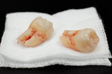 Çekilen diş, beyaz bir gazlı bez, diş cerrahisi konsepti, çekilen bir dişin Macro fotoğrafı, ve gazlı bez pedi..