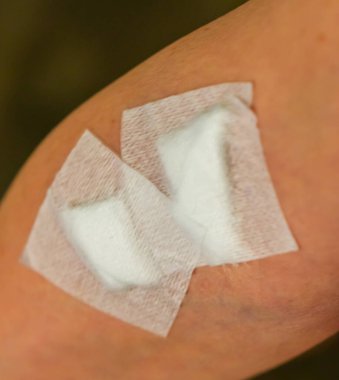 Doğum lekesi kaldırıldıktan sonra yara bandıyla kaplanmış.