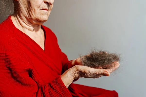 balding grandmother from chemotherapy. hair loss in a woman due to a cancerous tumor. a piece of hair in grandmother\'s hands because of cancer