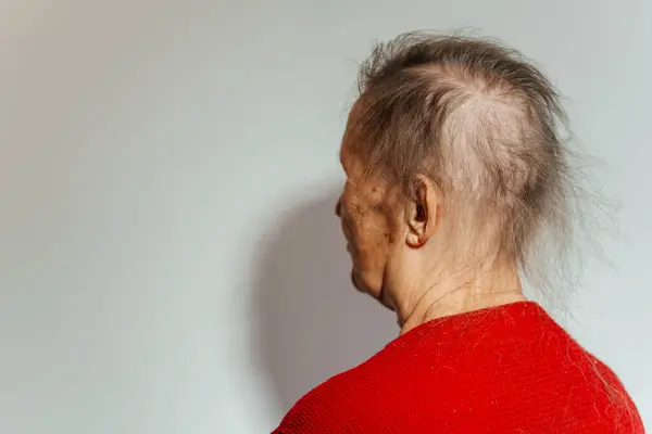 fallen hair from a woman\'s head due to a cancerous tumor. balding grandmother due to chemotherapy. a woman\'s balding head due to cancer.