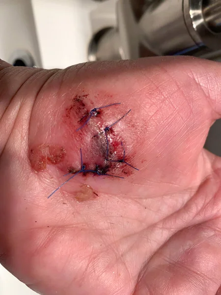 Τραυματισμός Στο Χέρι Ένα Μεγάλο Αιμορραγικό Τραύμα Που Ήταν Ραμμένο — Φωτογραφία Αρχείου