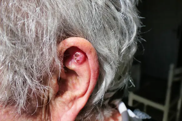 UVA 'ya aşırı maruz kalmaktan dolayı kulak üzerinde bazal hücre kanseri, özellikle de güneş ışığı nedeniyle, ameliyatla alınması gerekmektedir.