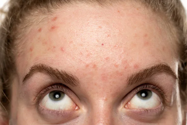 Akne Auf Der Stirn Einer Jungen Frau Gesichtshaut Problemkonzept — Stockfoto