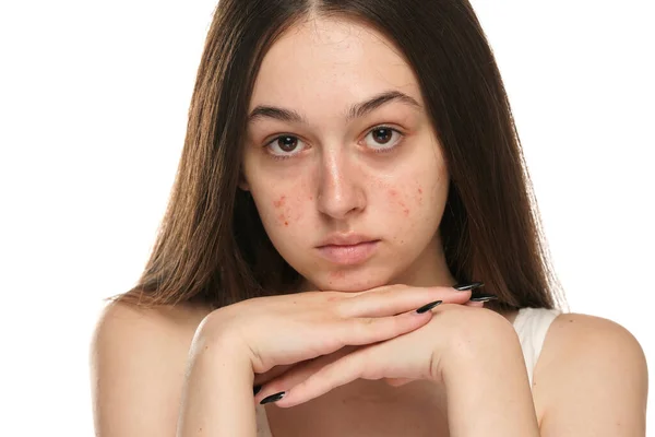 Красиві Молоді Жінки Проблемною Шкірою — стокове фото
