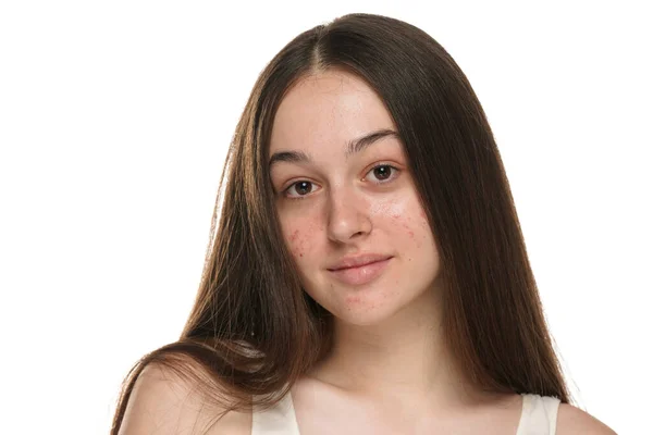 問題のある肌を持つ美しい若い笑顔の女性 — ストック写真