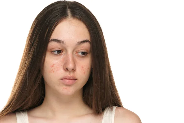 Vackra Unga Kvinnor Med Problematisk Hud — Stockfoto