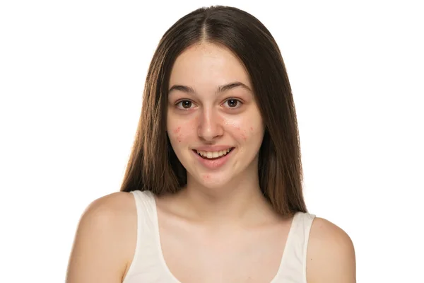 問題のある肌を持つ美しい若い笑顔の女性 — ストック写真