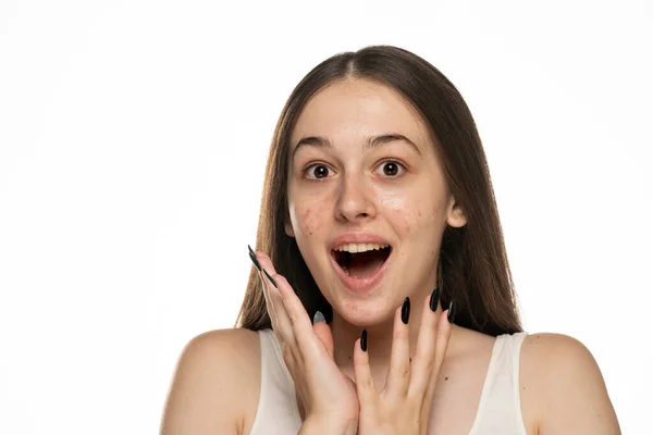 Mooie Jonge Glimlachende Vrouwen Met Problematische Huid Witte Achtergrond — Stockfoto