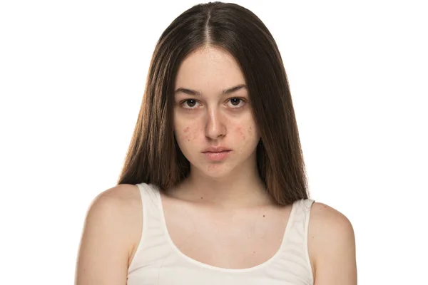 Piękne Młode Kobiety Problematyczną Skórą Białym Tle — Zdjęcie stockowe