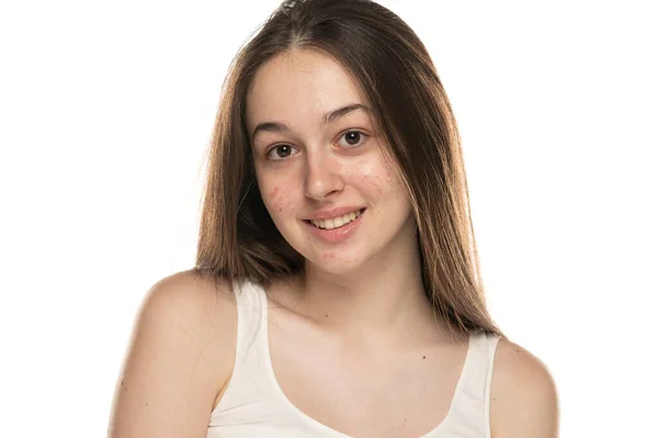 Красиві Молоді Усміхнені Жінки Проблемною Шкірою Білому Тлі — стокове фото
