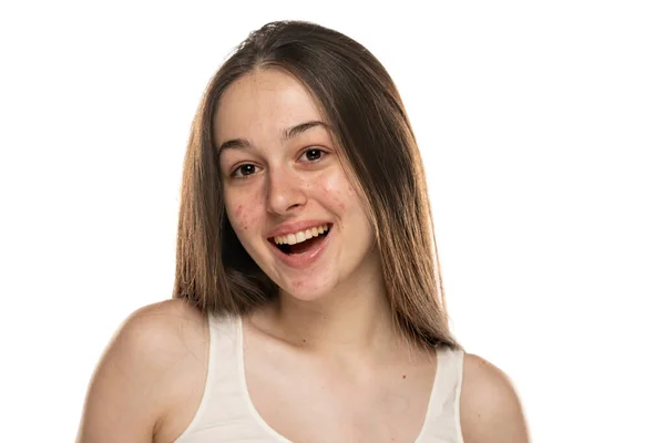 Krásné Mladé Usměvavé Ženy Problematickou Pletí Bílém Pozadí — Stock fotografie