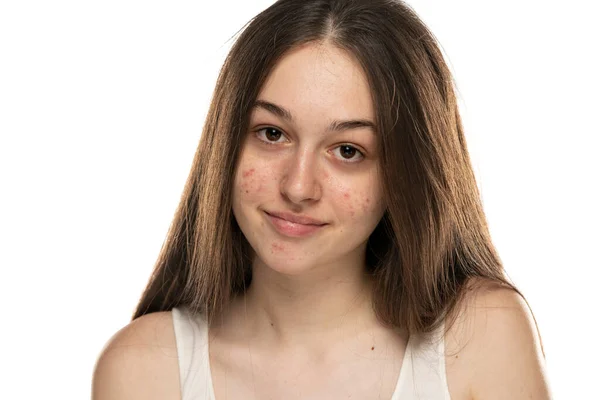 Beyaz Arka Planda Sorunlu Ciltli Gülümseyen Güzel Genç Kadınlar — Stok fotoğraf