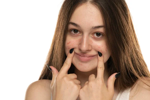 Schöne Junge Frauen Mit Problematischer Haut Die Mit Ihren Fingern — Stockfoto