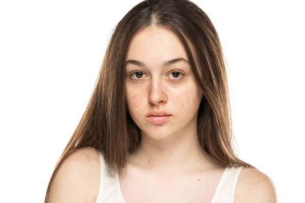 Piękne Młode Kobiety Problemati Skóry Białym Tle — Zdjęcie stockowe