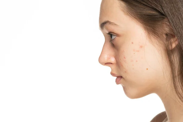 Profile Beautiful Young Women Problematic Skin — Stock Photo, Image