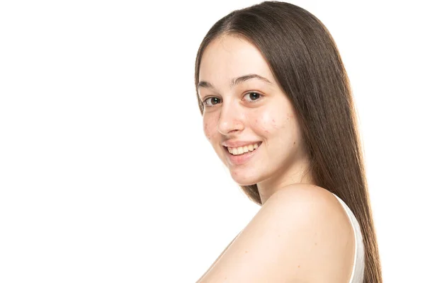 Belle Giovani Donne Sorridenti Con Pelle Problematica Sfondo Bianco — Foto Stock