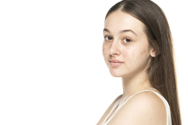 Hermosas Mujeres Jóvenes Sonrientes Con Piel Problemática Sobre Fondo Blanco — Foto de Stock