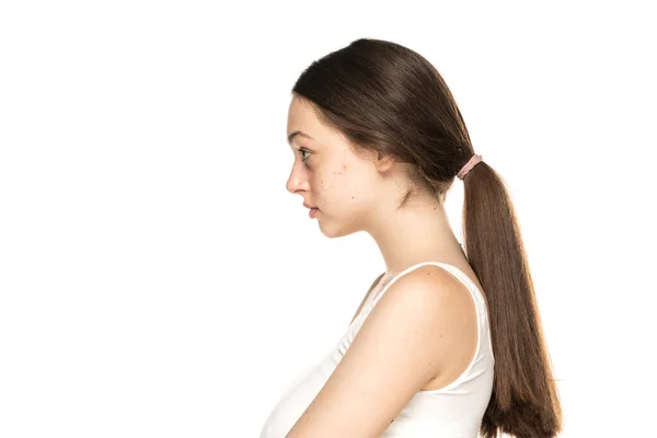 Profile Young Women Problematic Skin White Background — Stock Photo, Image