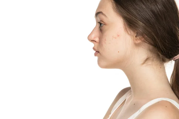 Profil Young Women Problematic Skin Sur Fond Blanc — Photo