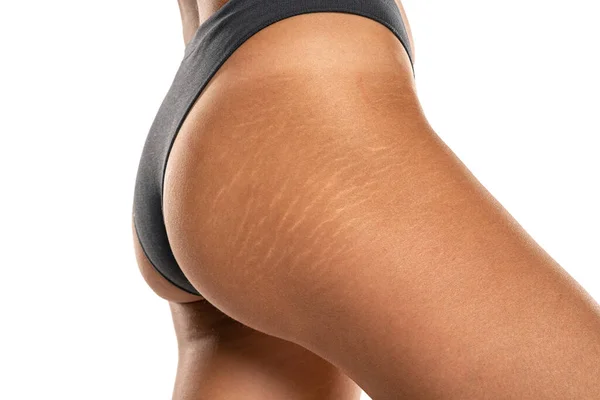 Female Tanned Hips Stretch Marks Cellulite White Studio Background — Foto de Stock