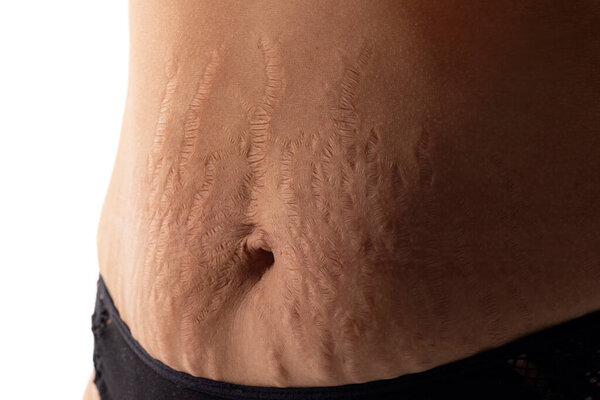 Female belly with stretch marks closeup