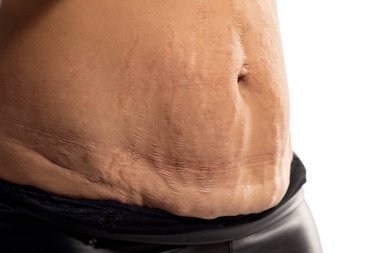 Woman with loose skin and stretch marks on her belly after pregnancy. Close up clipart