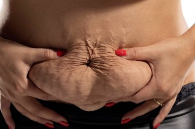 Hamilelikten sonra göbeğinde gevşek deri ve gerilme izleri olan bir kadın.
