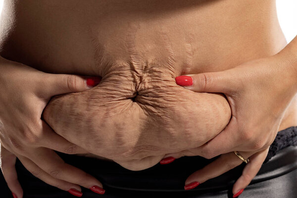 Woman displaying loose skin and stretch marks on her belly after pregnancy