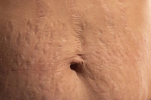 Close Menselijke Huid Natuurlijke Striae Textuur Achtergrond Strek Merk Vrouw — Stockfoto