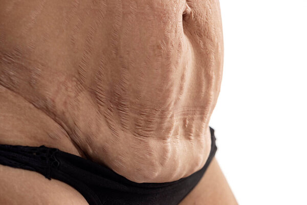 Woman with loose skin and stretch marks on her belly after pregnancy. Close up