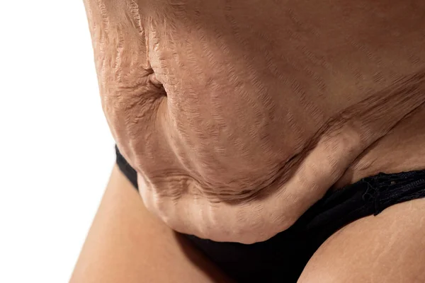 Γυναίκα Χαλαρό Δέρμα Και Ραγάδες Στην Κοιλιά Της Μετά Την — Φωτογραφία Αρχείου