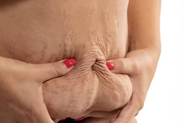 Donna Che Mostra Pelle Allentata Smagliature Sulla Pancia Dopo Gravidanza — Foto Stock
