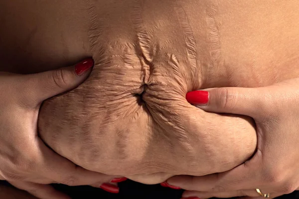 Γυναίκα Εμφανίζει Χαλαρό Δέρμα Και Ραγάδες Στην Κοιλιά Της Μετά — Φωτογραφία Αρχείου