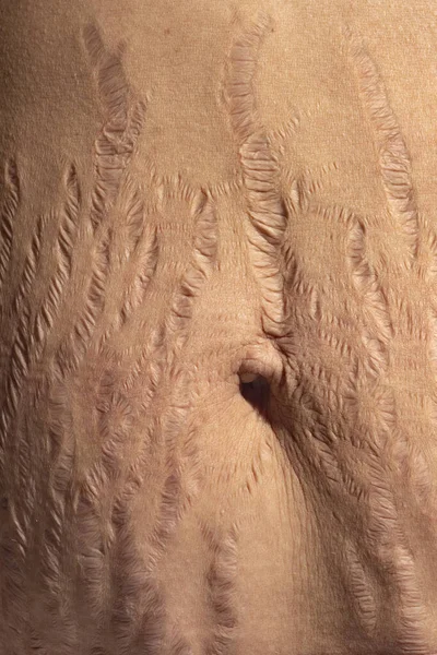 Κοντινό Πλάνο Ανθρώπινο Δέρμα Φυσικό Ραγάδες Υφή Φόντο Κοιλιά Γυναίκα — Φωτογραφία Αρχείου