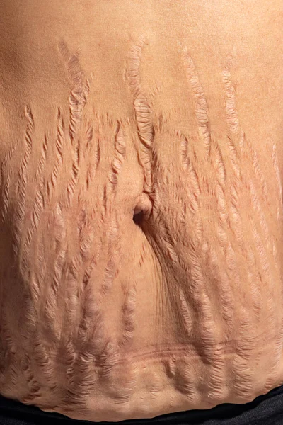 Närbild Mänsklig Hud Naturliga Bristningar Textur Bakgrund Stretch Märke Kvinna — Stockfoto