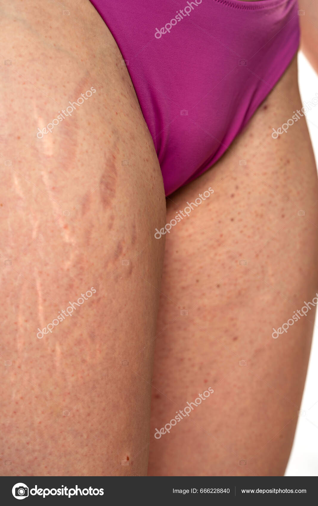 Female Hip Stretch Marks Groin Dots Acne Sensitive Problematic Skin Stock  Photo by ©VGeorgiev 666228840